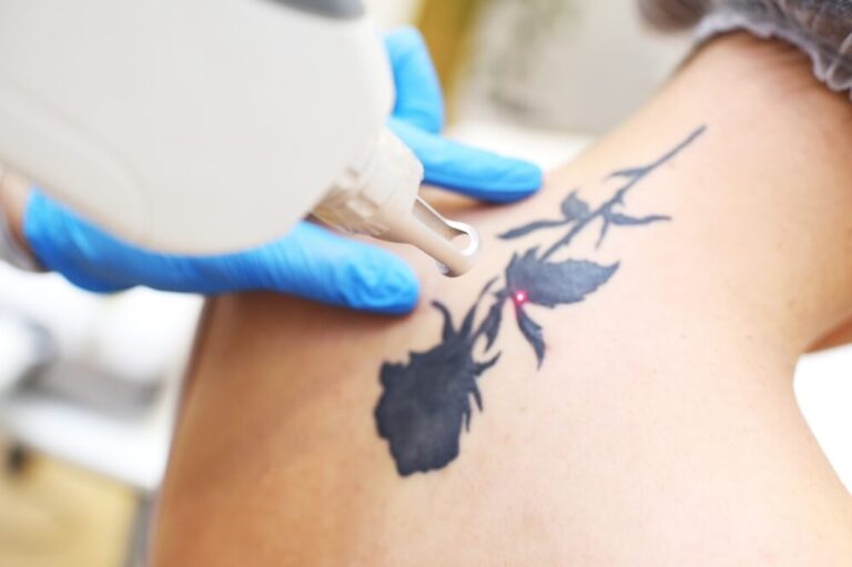 usuwanie tatuazu wroclaw